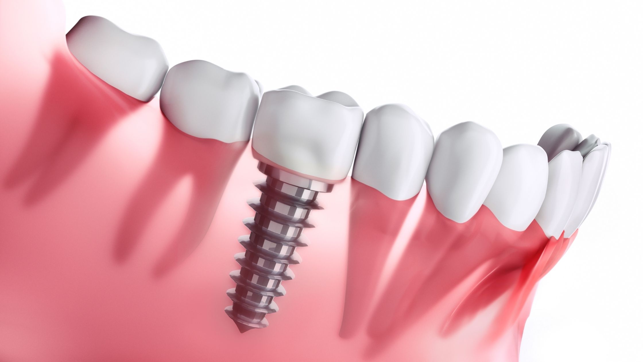 Affordable Dental Implants in St. George, Utah: Restore Your Smile at Virgin River Dental