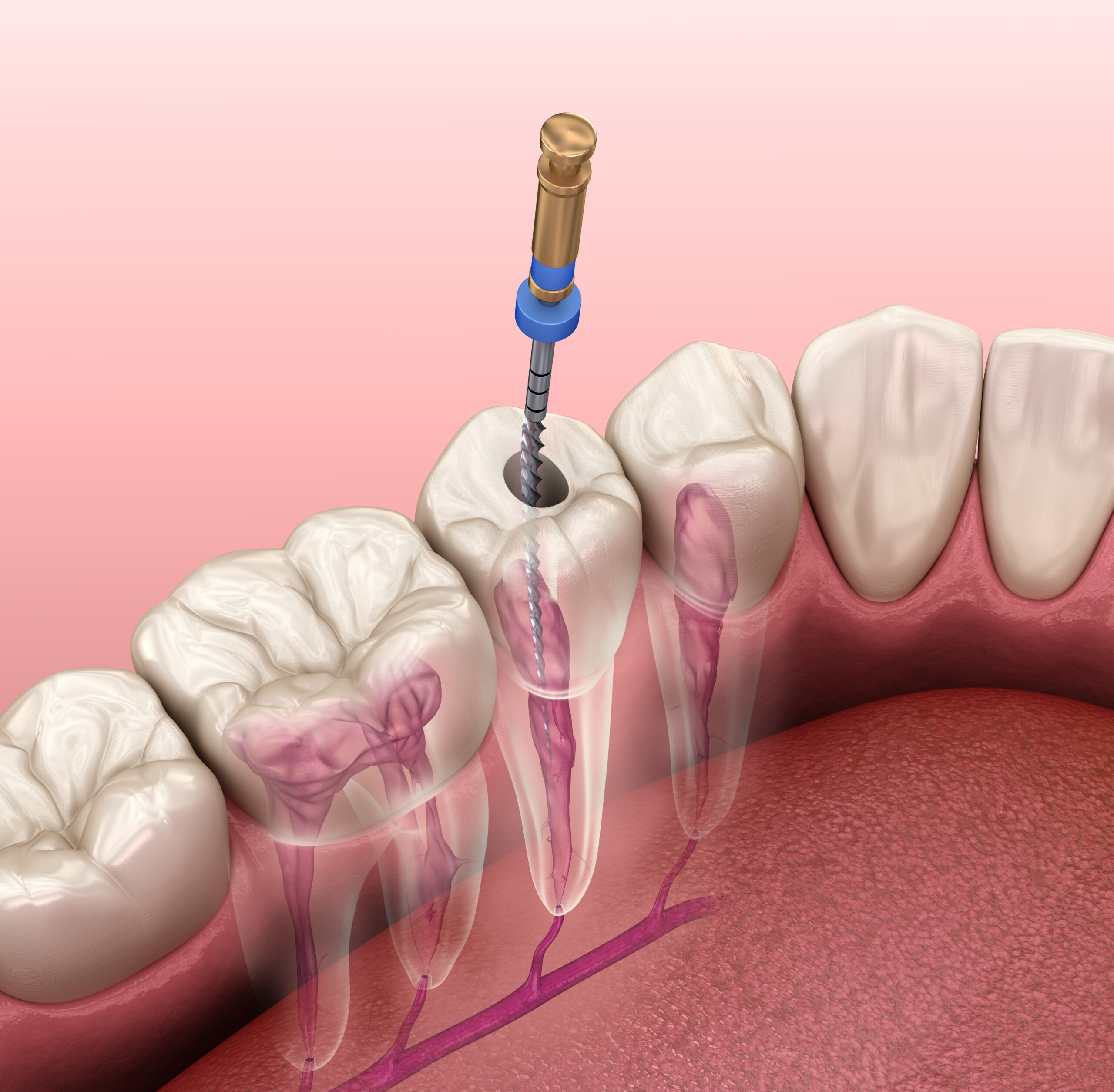 Signs You Need a Root Canal: Symptoms You Shouldn’t Ignore