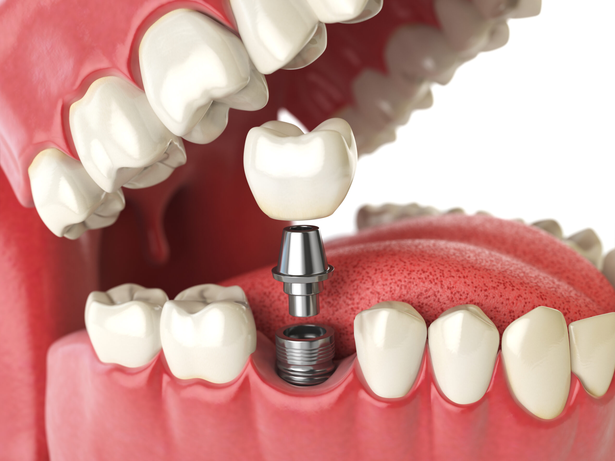 When Should You Choose a Bridge vs. a Dental Implant?