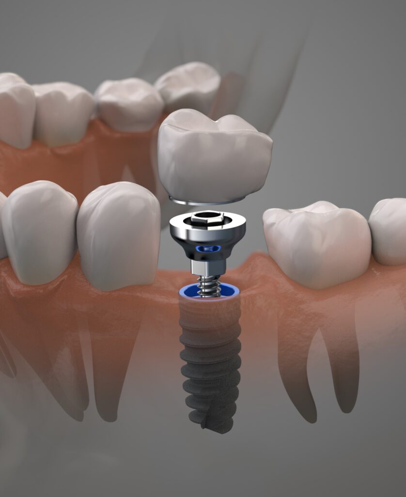 Tooth human implant. On1 concept. Dental prosthetic innovation. 3d illustration.